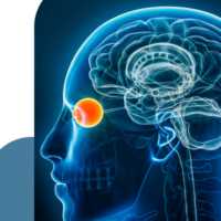 La Cerebral Visual Impairment (CVI) dalla diagnosi alla terapia: la necessità di un approccio multidisciplinare